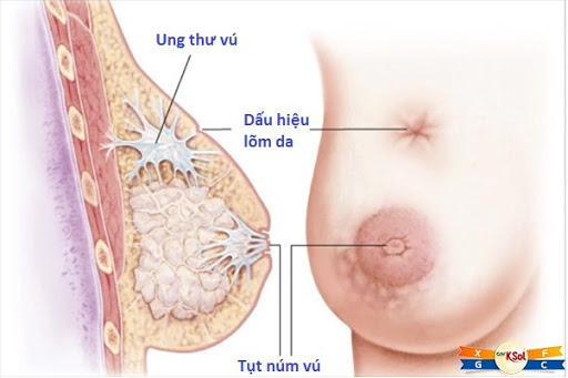 Ung thư vú tại Việt Nam