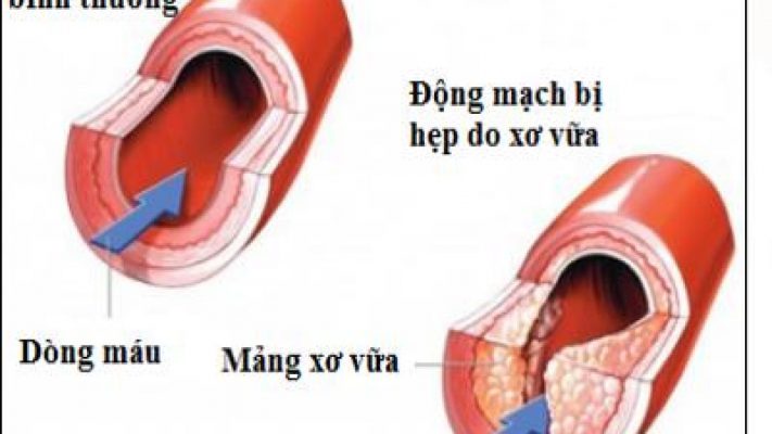 Xơ vữa động mạch