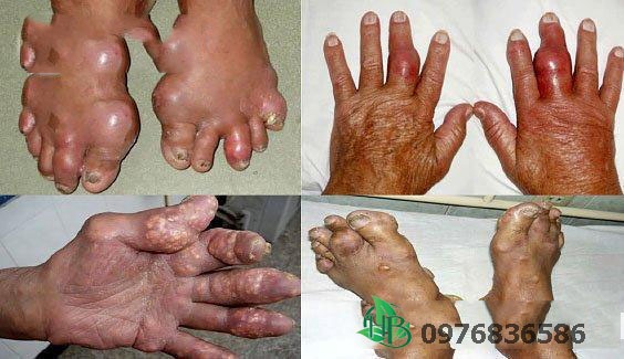 Thổ phục linh khắc tinh của bệnh Gout