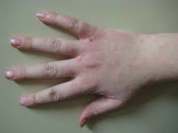 Bệnh Eczema