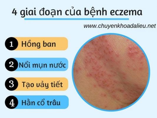 Biểu hiện của bệnh eczema