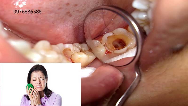 Bệnh đau răng
