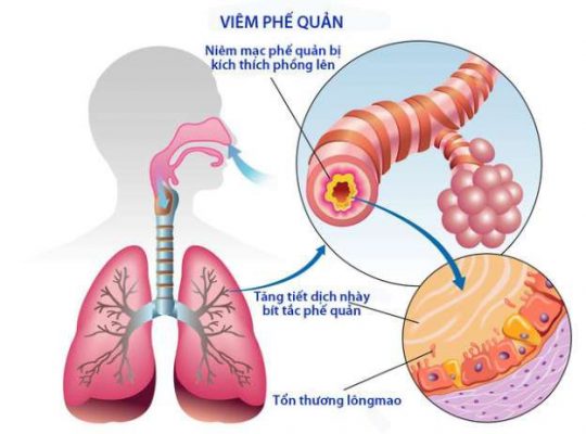 Bài thuốc hỗ trợ điều trị viêm phế quản từ mạch môn