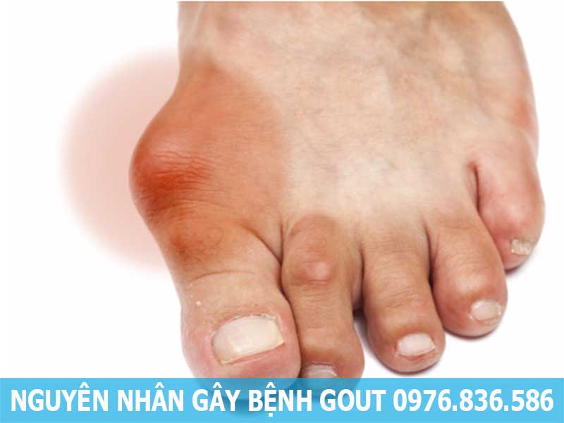 nguyên nhân gây bệnh gout