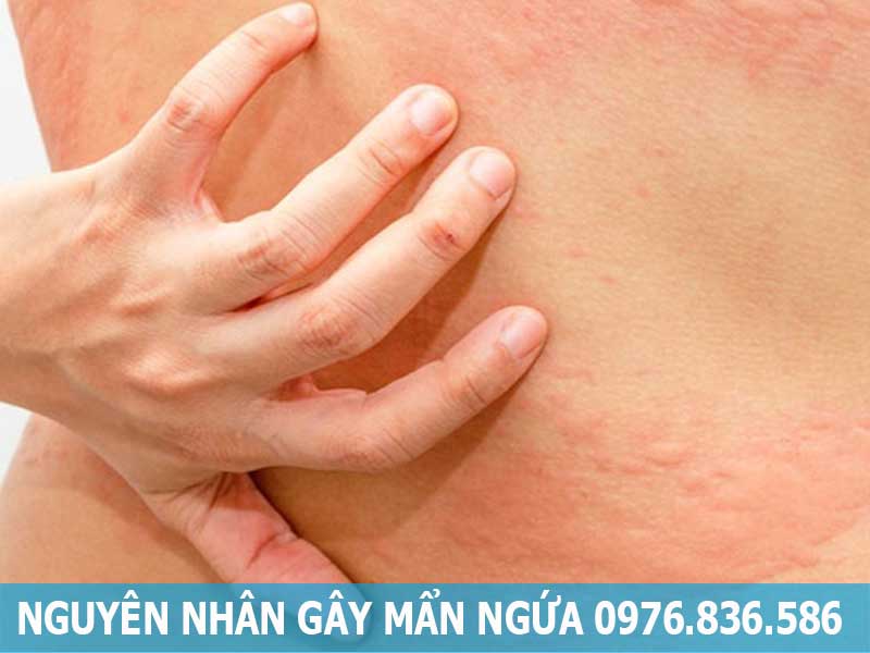 nguyên nhân gây mẩn ngứa ngoài da