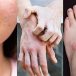 44 Bài thuốc Hỗ trợ chữa trị mẩn ngứa và bệnh ngoài da