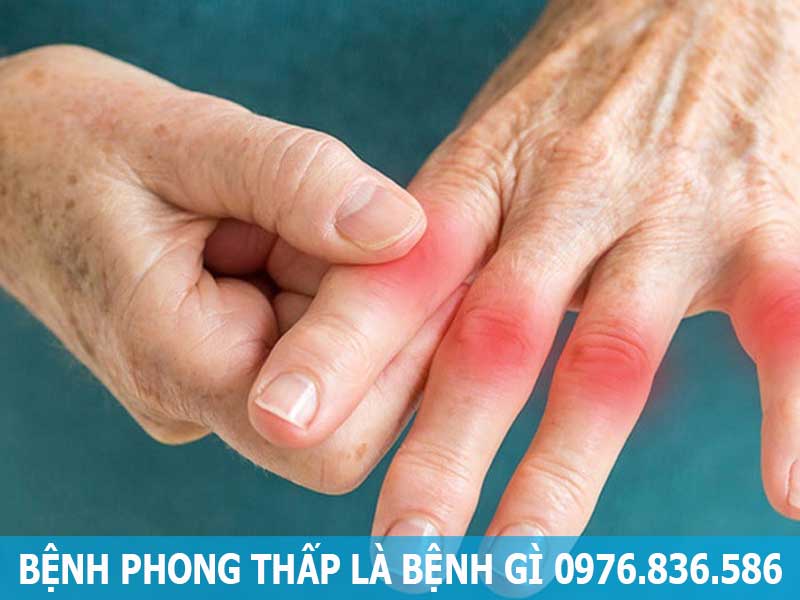 bệnh phong thấp là bệnh gì