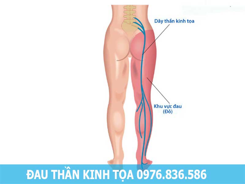 nguyên nhân đau thần kinh tọa