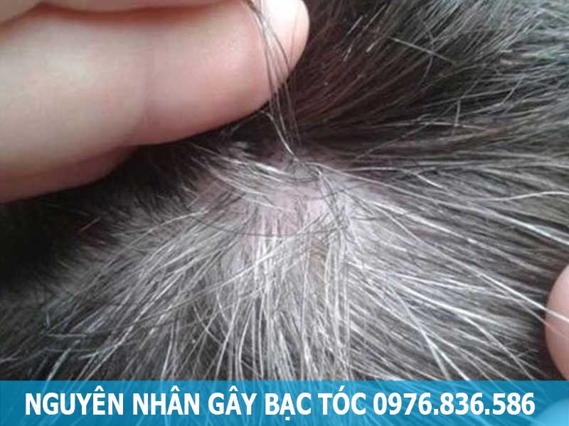 nguyên nhân gây bạc tóc