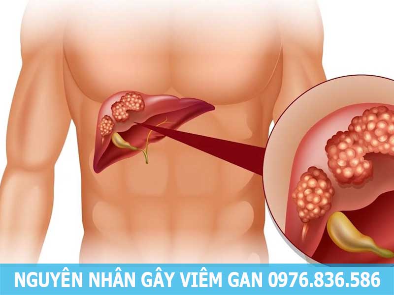 nguyên nhân gây bệnh viêm gan