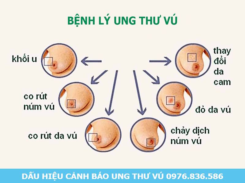 Tổng quan về bệnh lý ung thư vú