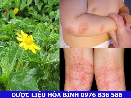 sài đất trị mẩn ngứa ngoài da