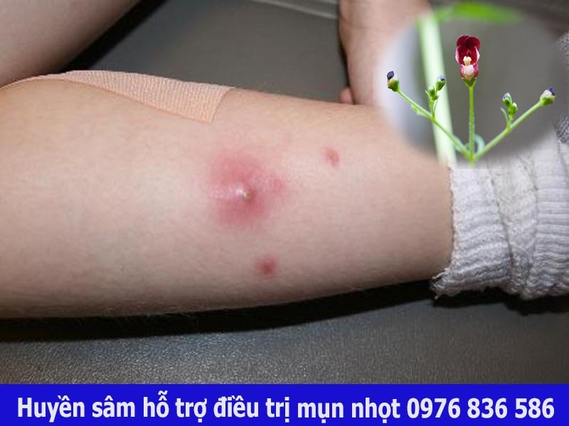 Huyền sâm hỗ tợ điều trị mụn nhọt